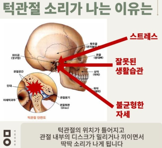 입만 크게 벌려도 딱딱 소리나는 턱관절 장애 관련 이미지