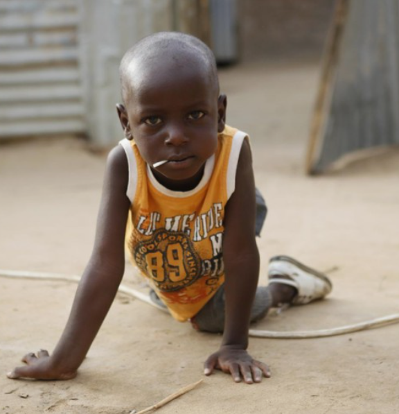 폴리오-소아마비-증상