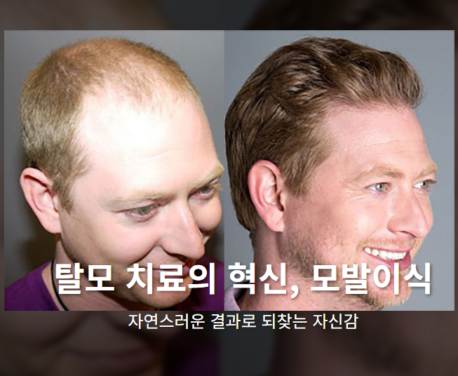 모발이식 3000모