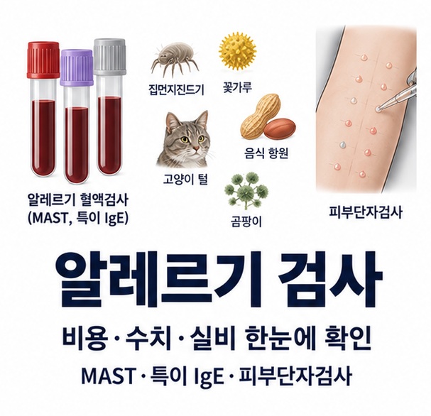 알레르기 검사 비용 수치 실비와 MAST 특이 IgE 피부단자검사를 한눈에 보여주는 의료 교육용 이미지