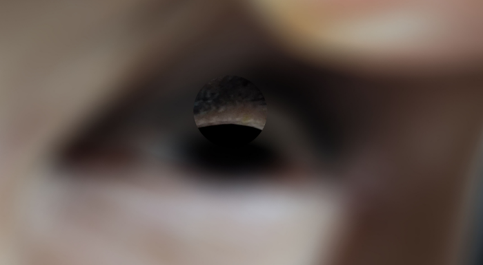 다래끼_치료_22