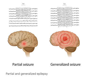 뇌전증 전신발작과 부분발작의 차이