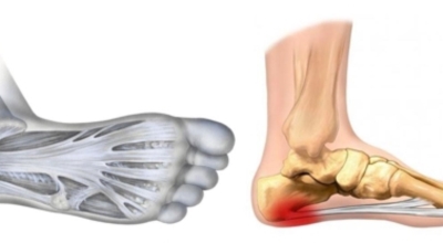 족저근막염 이미지