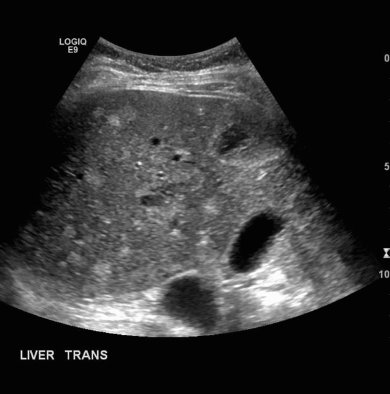 bile duct hamartomas