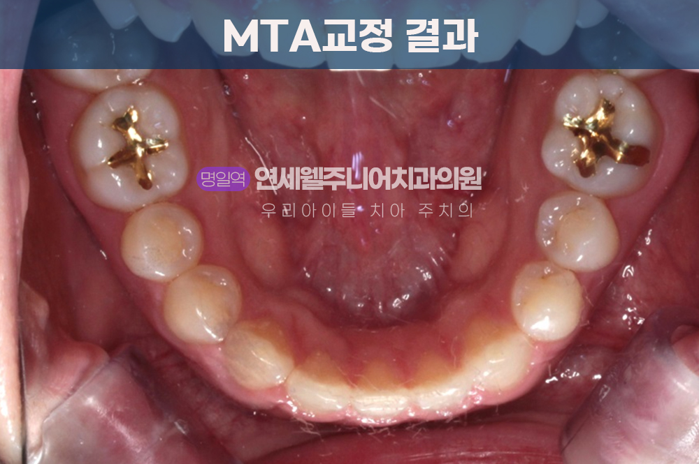 MTA 교정치료 후 하악 치열