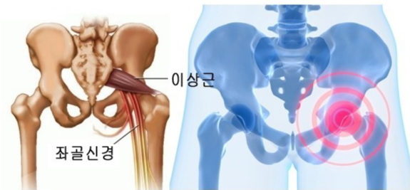 좌골 신경과 이상근