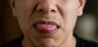 입이 쓴 증상 4가지 원인과 해결방법_9