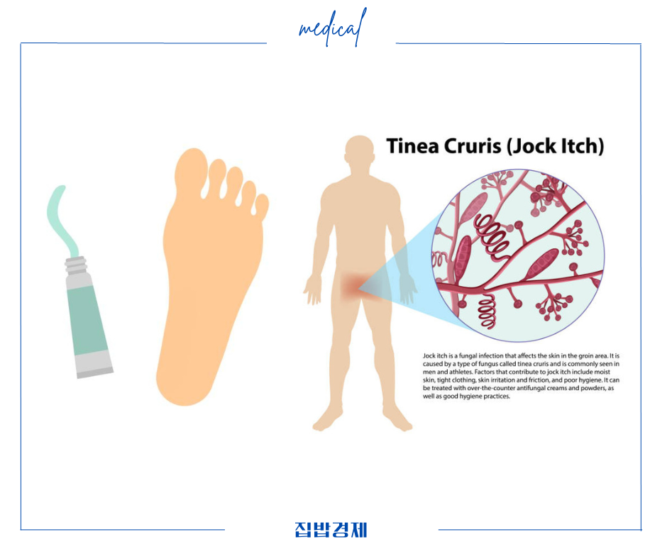 카네스텐 연고 사용법