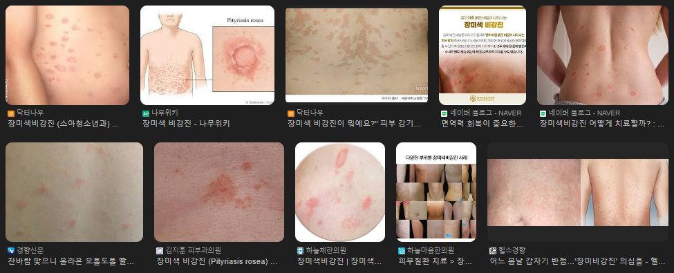 구글에서 장미색 비강진을 검색한 결과