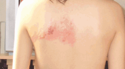 대상포진이미지