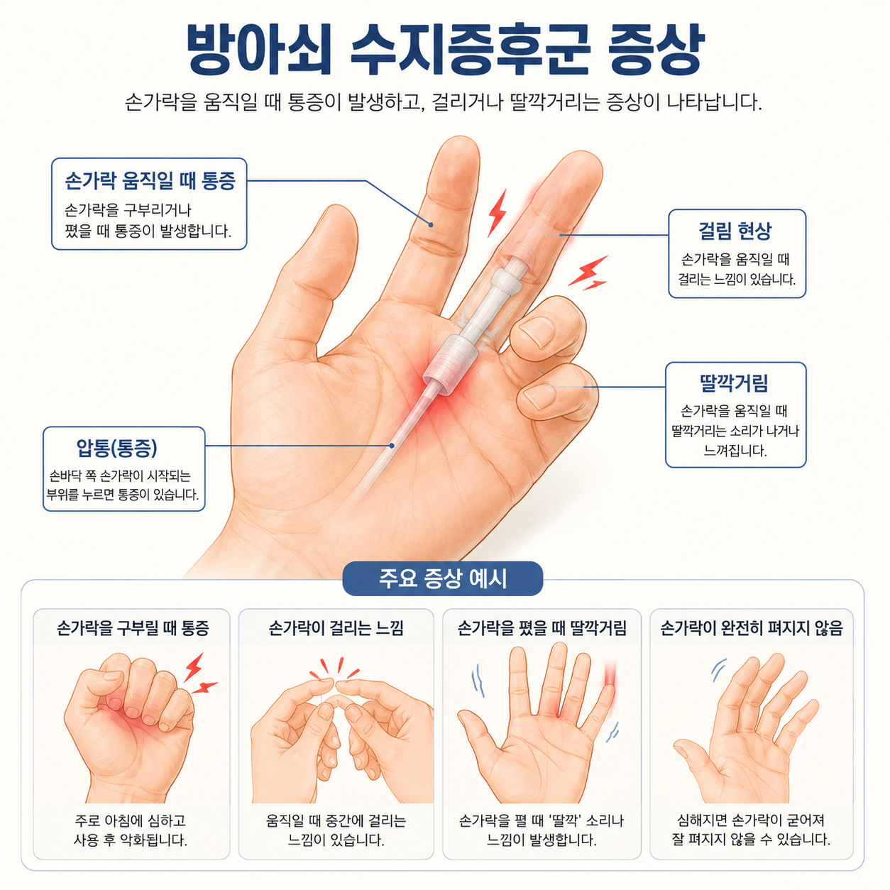 방아쇠 수지증후군 증상. 원인. 치료