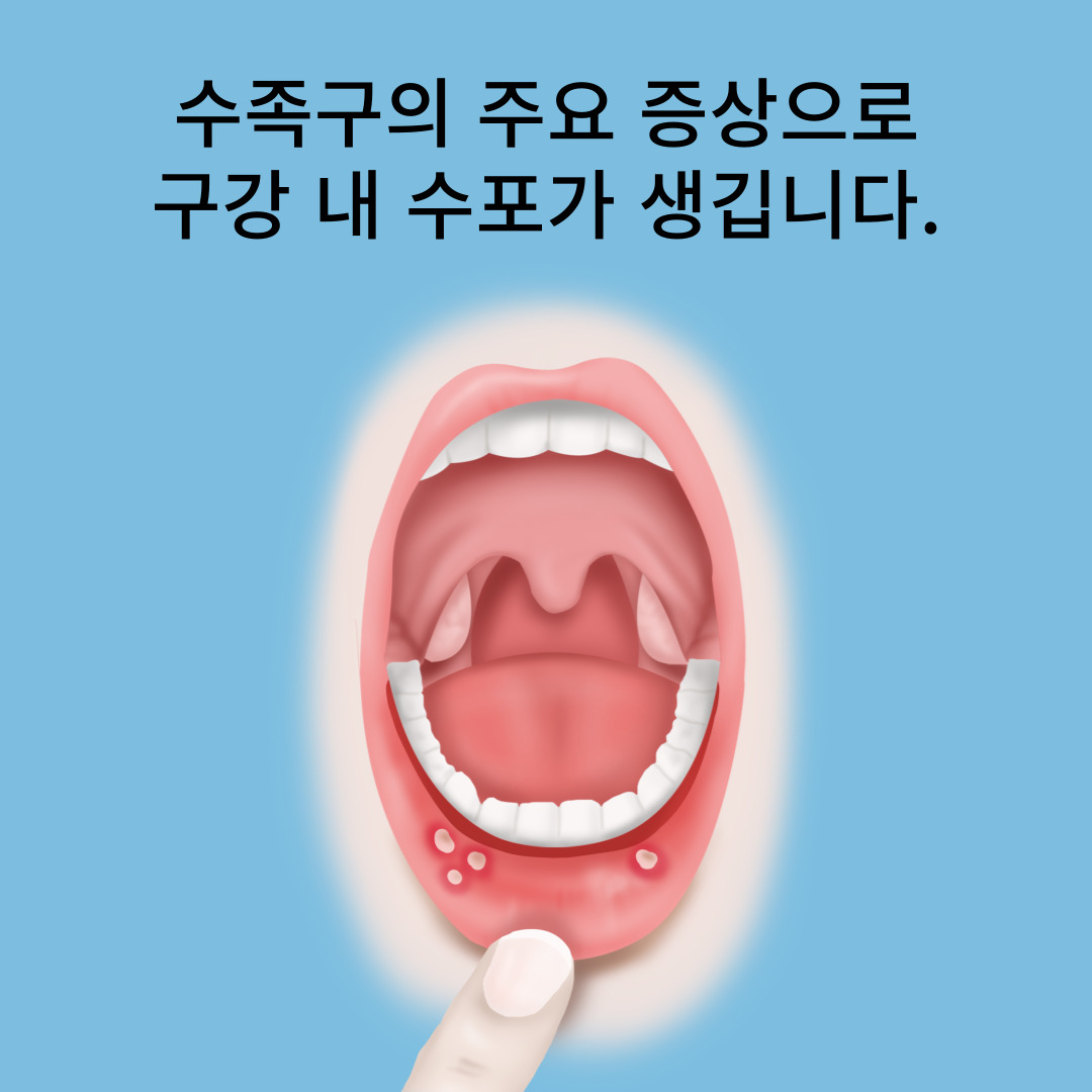 수족구병은-전염성이-매우-강합니다.