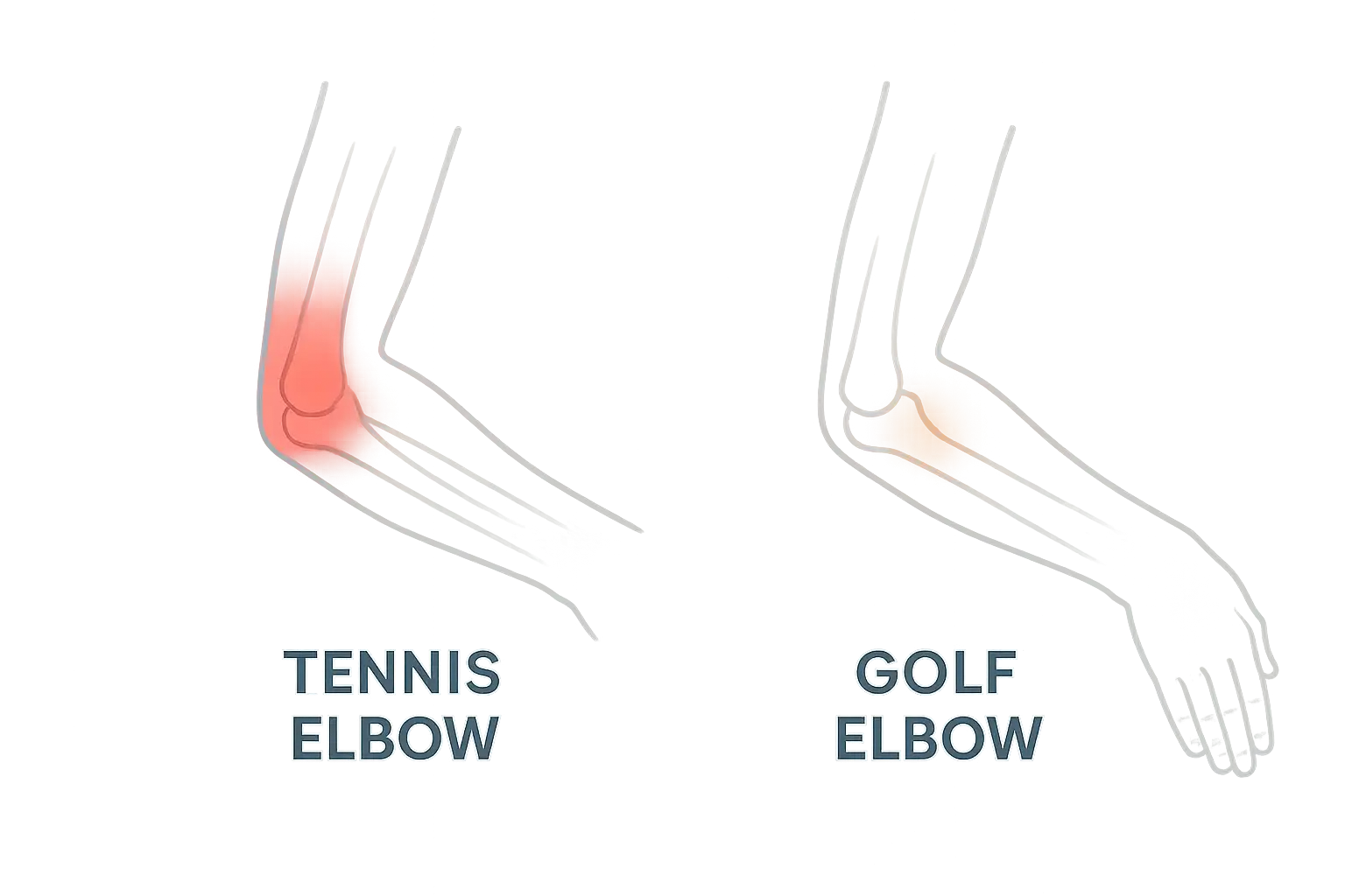 테니스엘보우와 골프엘보우 통증 부위 비교