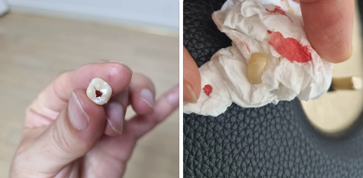 임플란트 크라운 깨짐