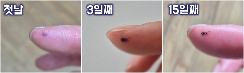 박쥐구아노 주의사항, 박쥐구아노 화상