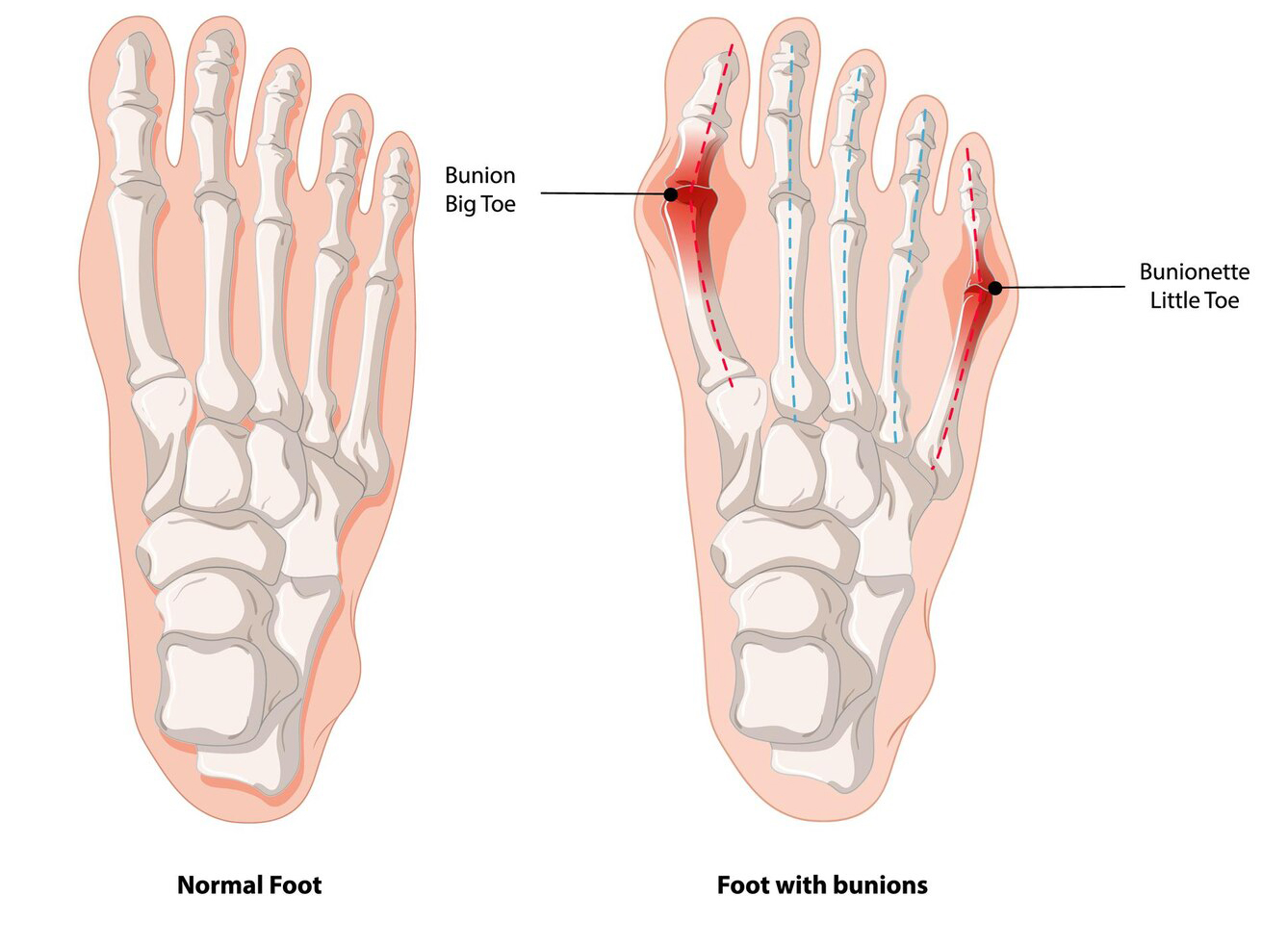 정상인의 발과 무지외반증 환자의 발 비교사진_무지외반증의 경우 뼈가 불룩 튀어나와있다.
