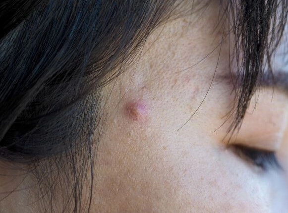 여드름 부위별 원인