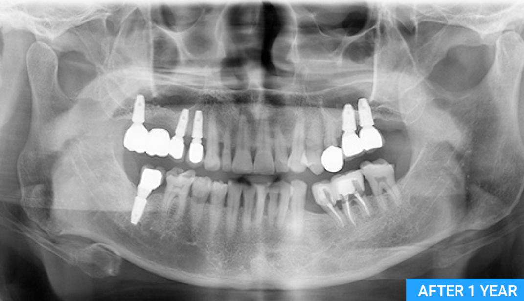 강남플란치과-임플란트가격-비용-시술후기-이벤트