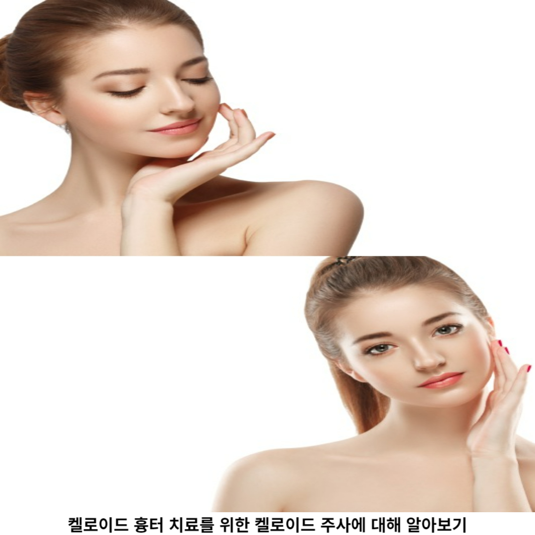 켈로이드 주사 치료 / 예방