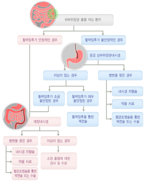하부위장관 출혈의 진단과 치료