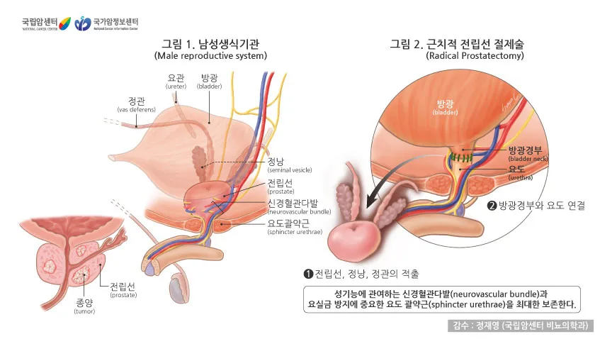 전립선암 초기증상