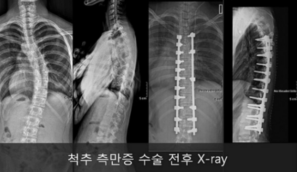 척추 측만증 수술