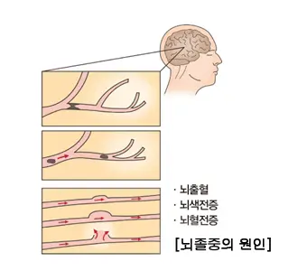 뇌졸중에 관한 이미지