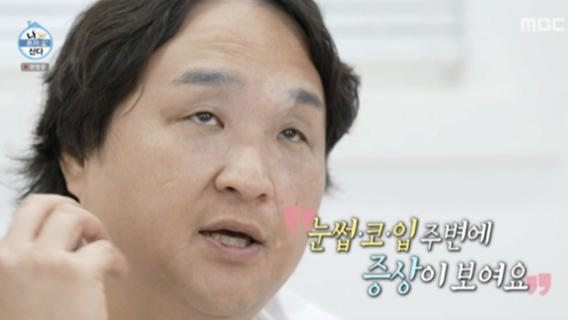 ‘나 혼자 산다’ 구성환의 백반증 투병 이야기