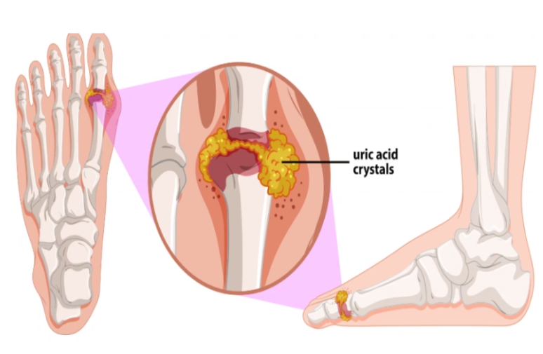 통풍발작 응급 대처 치료 방법 - 소염진통제 복용