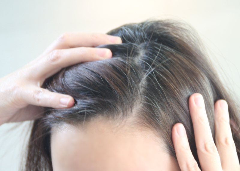 머리가 빠지는 현상 &amp;#39;탈모&amp;#39;