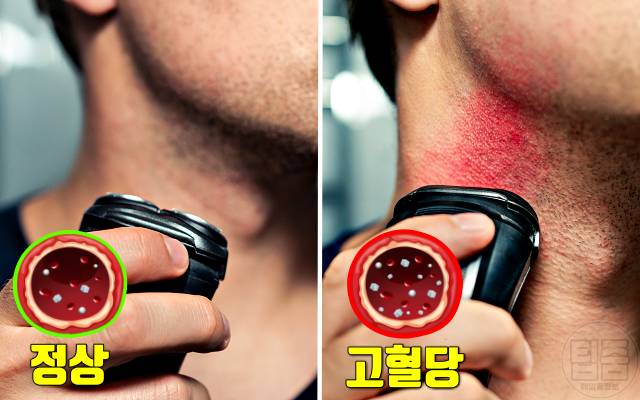 남자 당뇨 증상 특징 면도상처 내분비내과 전문의 피셜