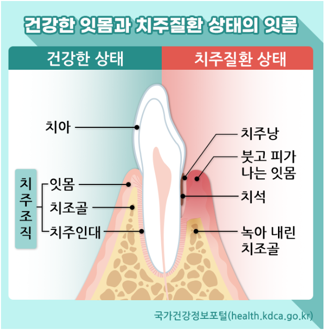 건강한 잇몸과 치주질환 상태의 잇몸