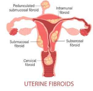 자궁근종 증상 7가지, 수술후 회복기간