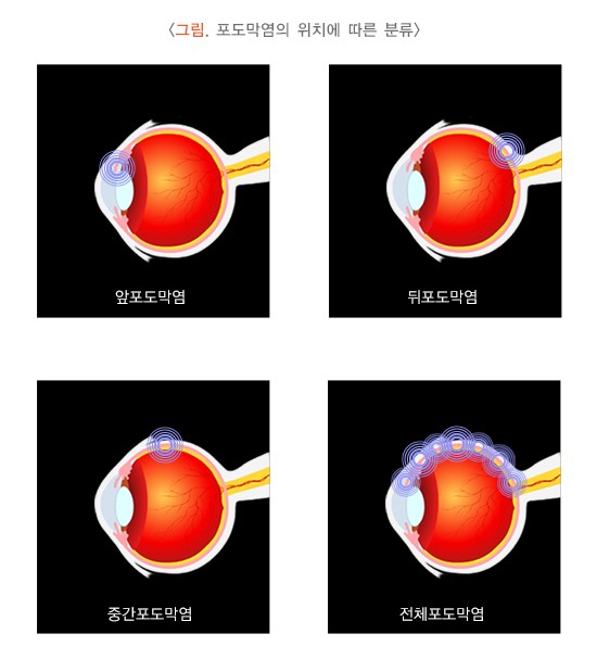 포도막염