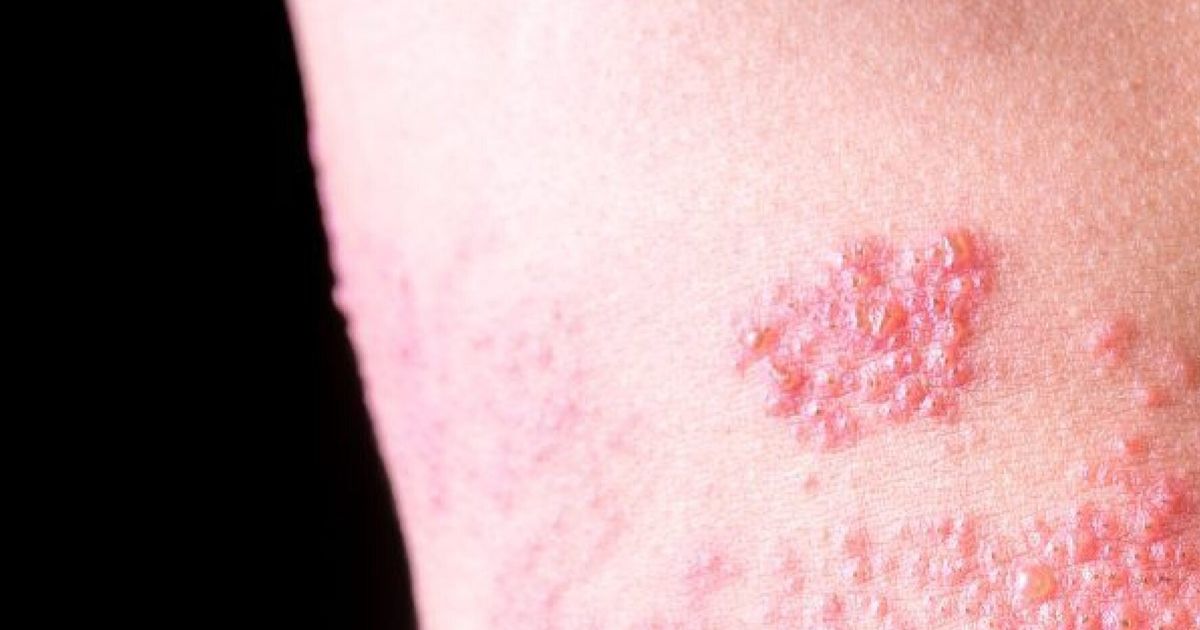 대상포진 예방접종 가격 (+ 최저가, 무료접종)