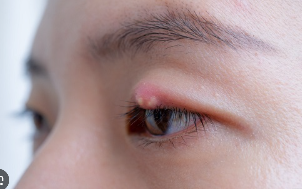 다래끼 빠르게 치료하는 방법