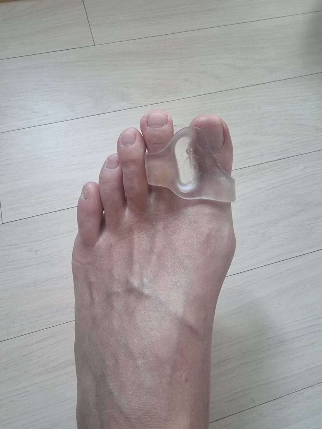 엄지발가락 통증인 무지외반증의 증상과 치료방법