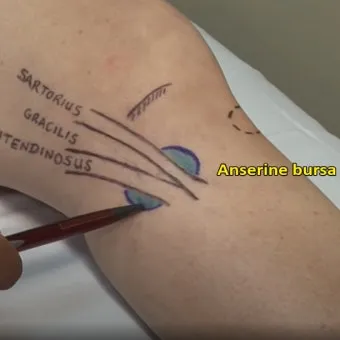 거위발 건염 원인과 증상 무릎 안쪽 통증 치료법 정리_17