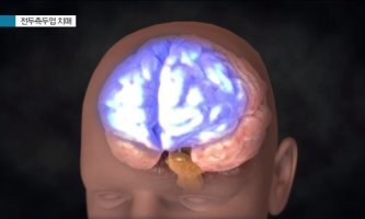 전두측두엽 치매