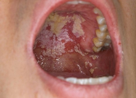 오엔지질연질캡슐은 비뇨생식기관용제 : 질칸디다증