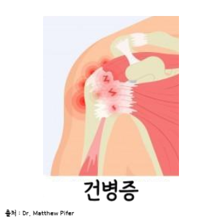 어깨통증원인