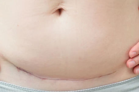 시카케어 겔시트 약국에서 사서, 제왕절개 배 흉터 관리했어요.