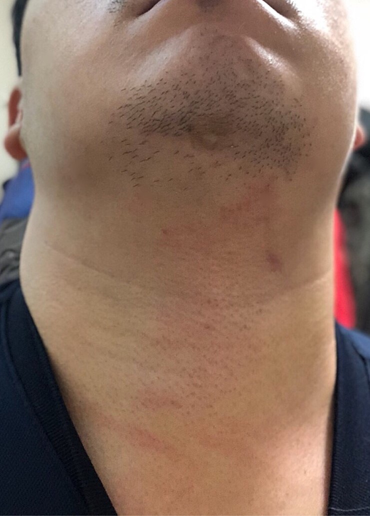 얼굴 지방흡입 후기