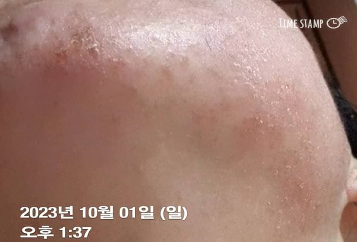 턱 접촉성 피부염