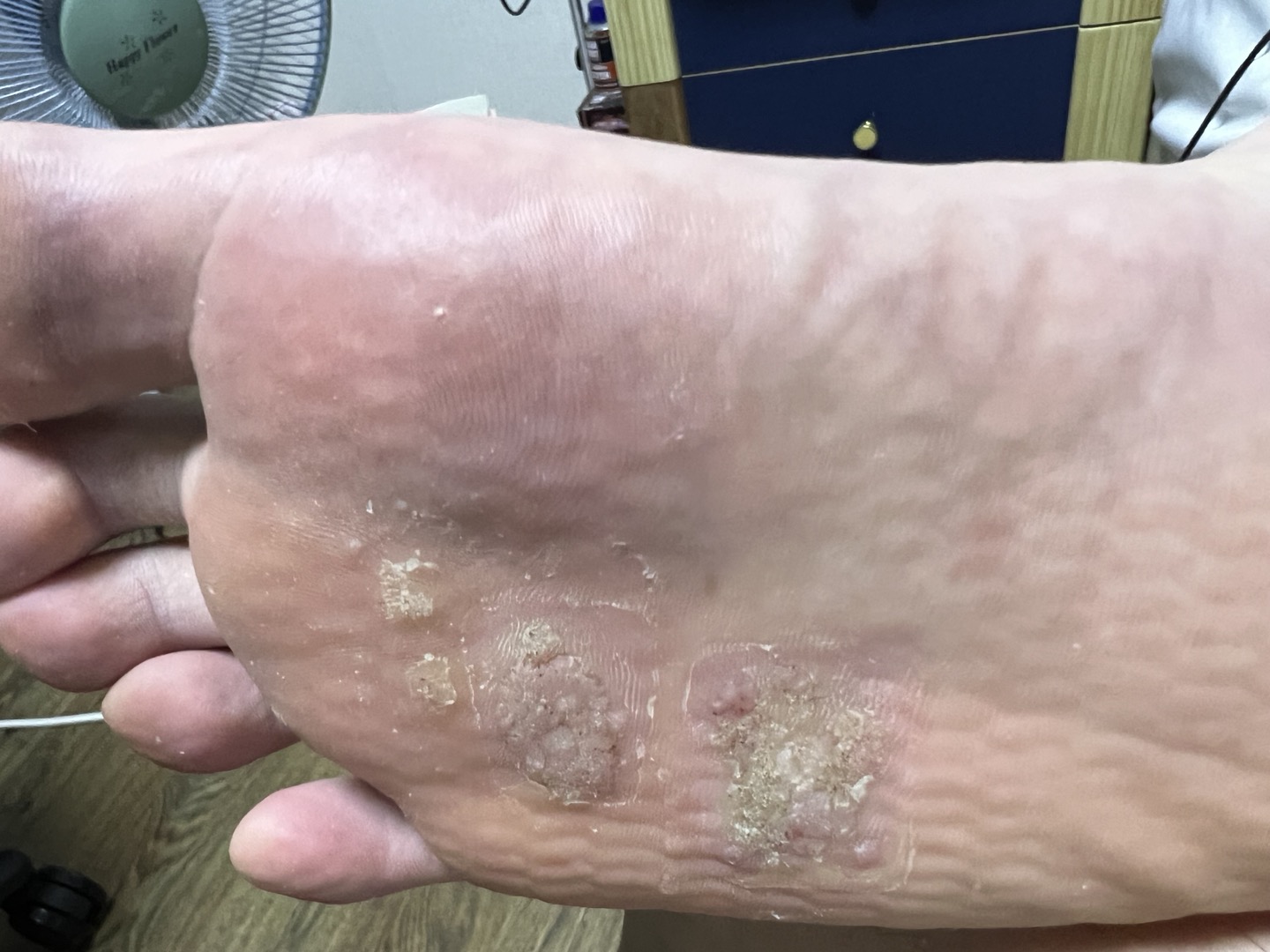 사마귀 자가치료