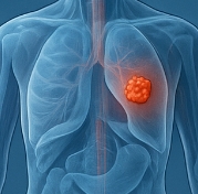 유방암 초기증상