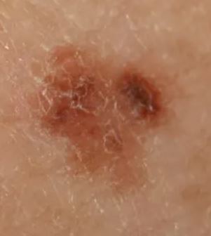 흑색종 피부암 모습