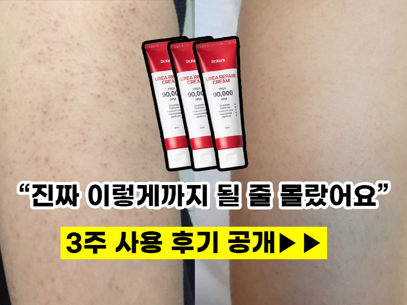 유레아 고함량 크림