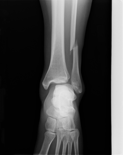 골절-Xray-구획증후군
