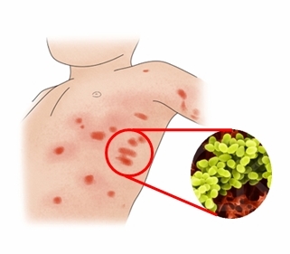 일본 전염병 유행 이유와 상황 